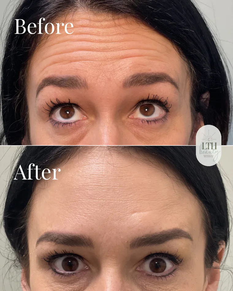 Before and after — neurotoxin treatment for forehead lines (upper-face view)