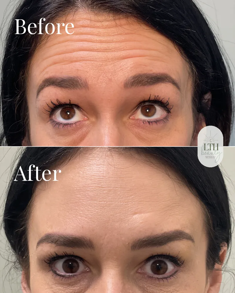 Before and after — neurotoxin treatment for forehead lines (upper-face view)