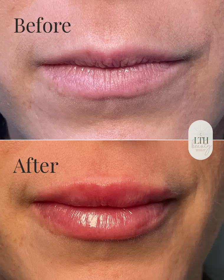 Before and after — lip filler (front view, lip close-up)
