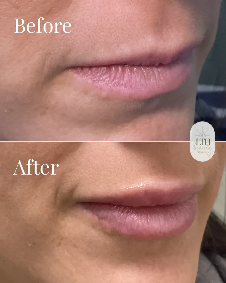 Before and after — lip filler (lip close-up)