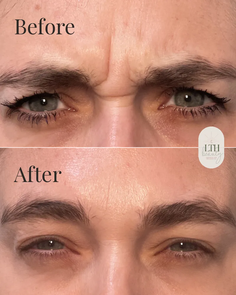 Before and after — neurotoxin treatment for frown lines, the 11s
