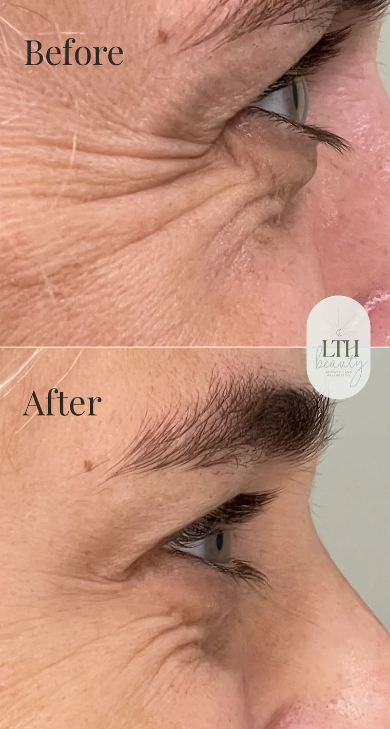 Before and after — neurotoxin treatment for crow's feet (side view)