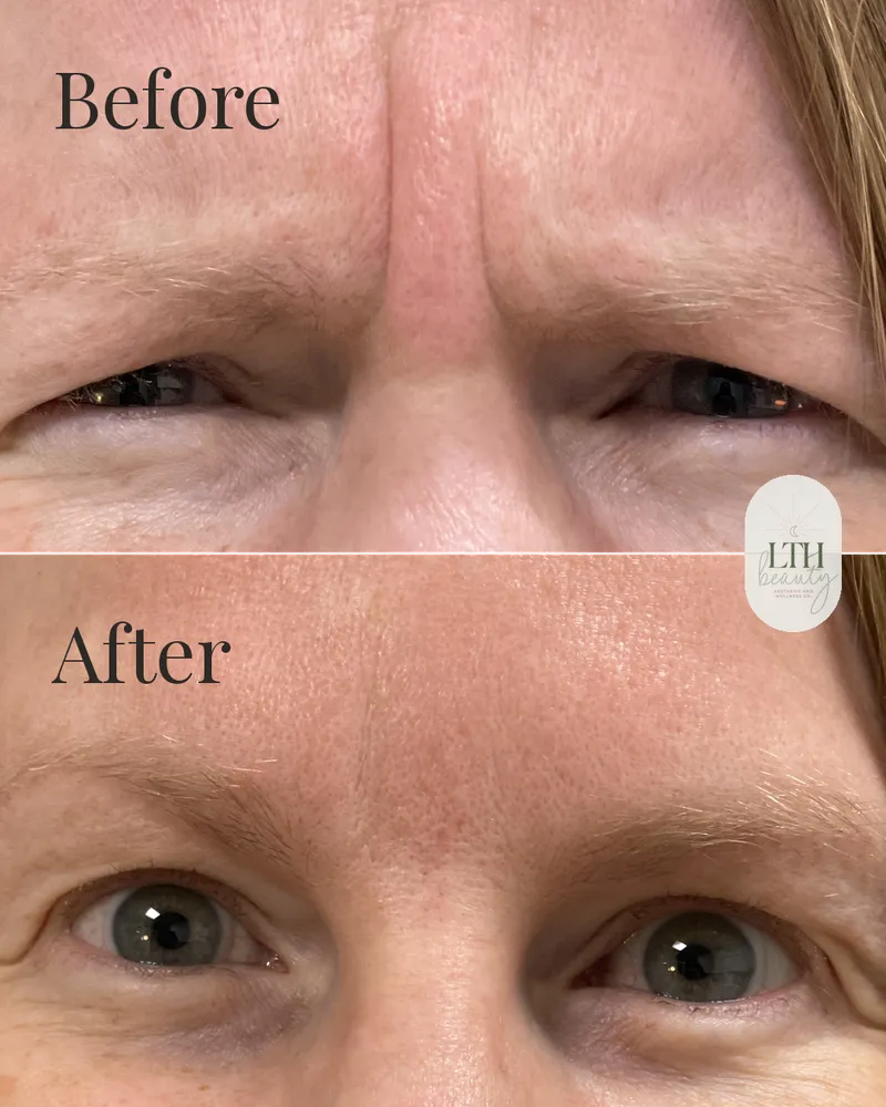 Before and after — neurotoxin treatment for frown lines, the 11s