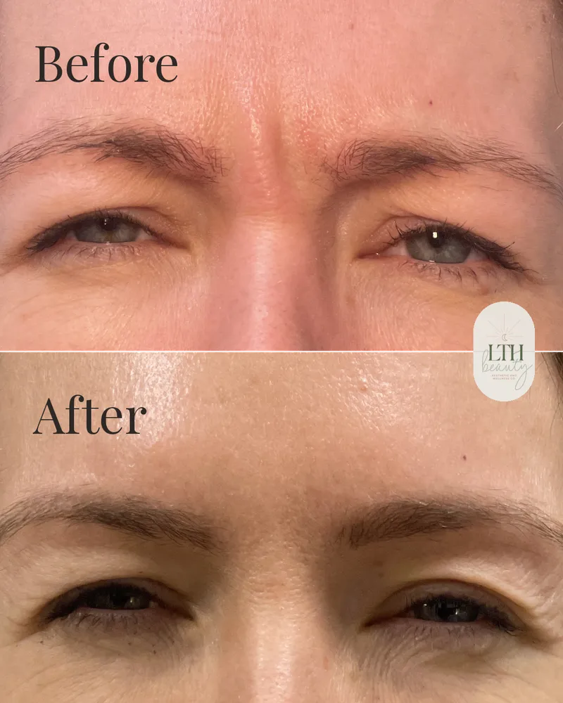 Before and after — neurotoxin treatment for frown lines, the 11s