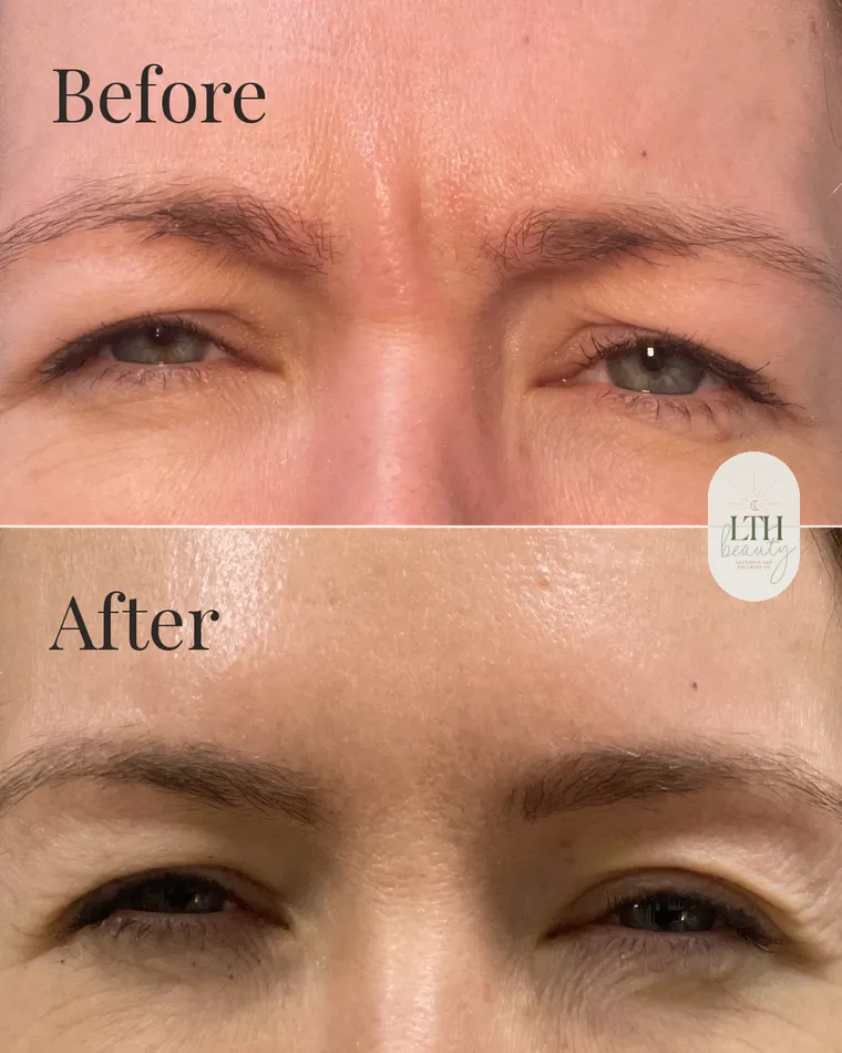 Before and after — neurotoxin treatment for frown lines, the 11s
