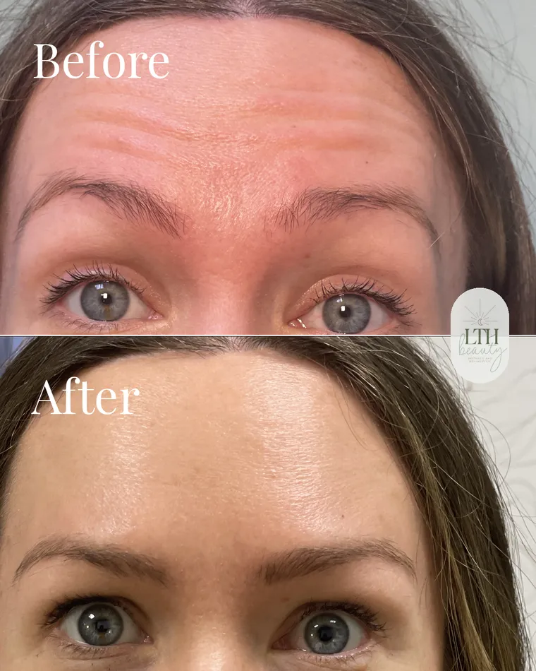 Before and after — neurotoxin treatment for forehead lines (return visit)