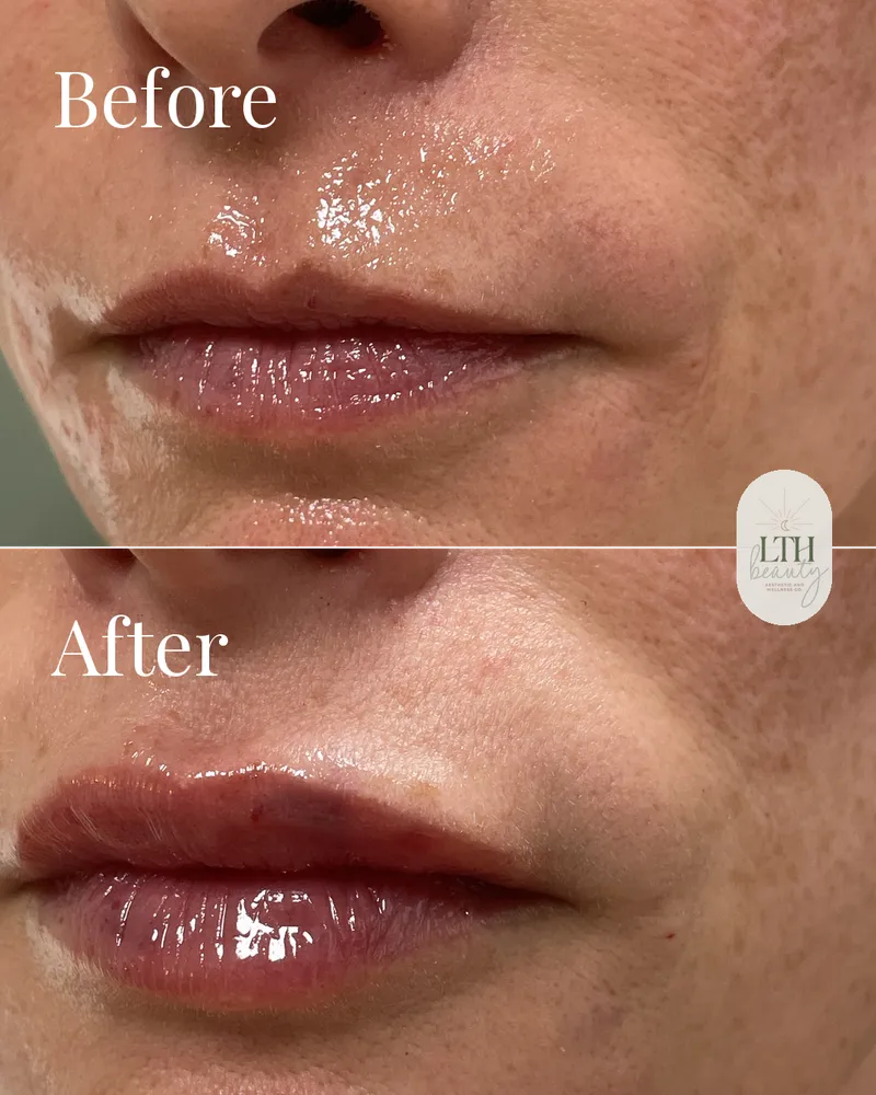 Before and after — lip filler