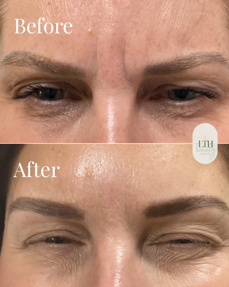 Before and after — neurotoxin treatment for frown lines, the 11s