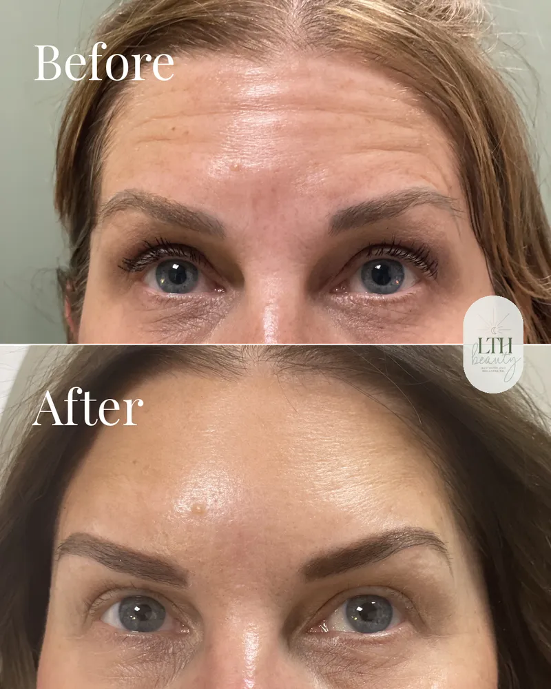 Before and after — neurotoxin treatment for forehead lines (upper-face view)