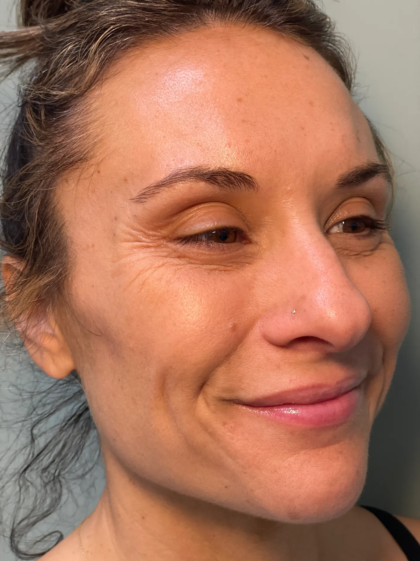 Patient after dermal filler treatment
