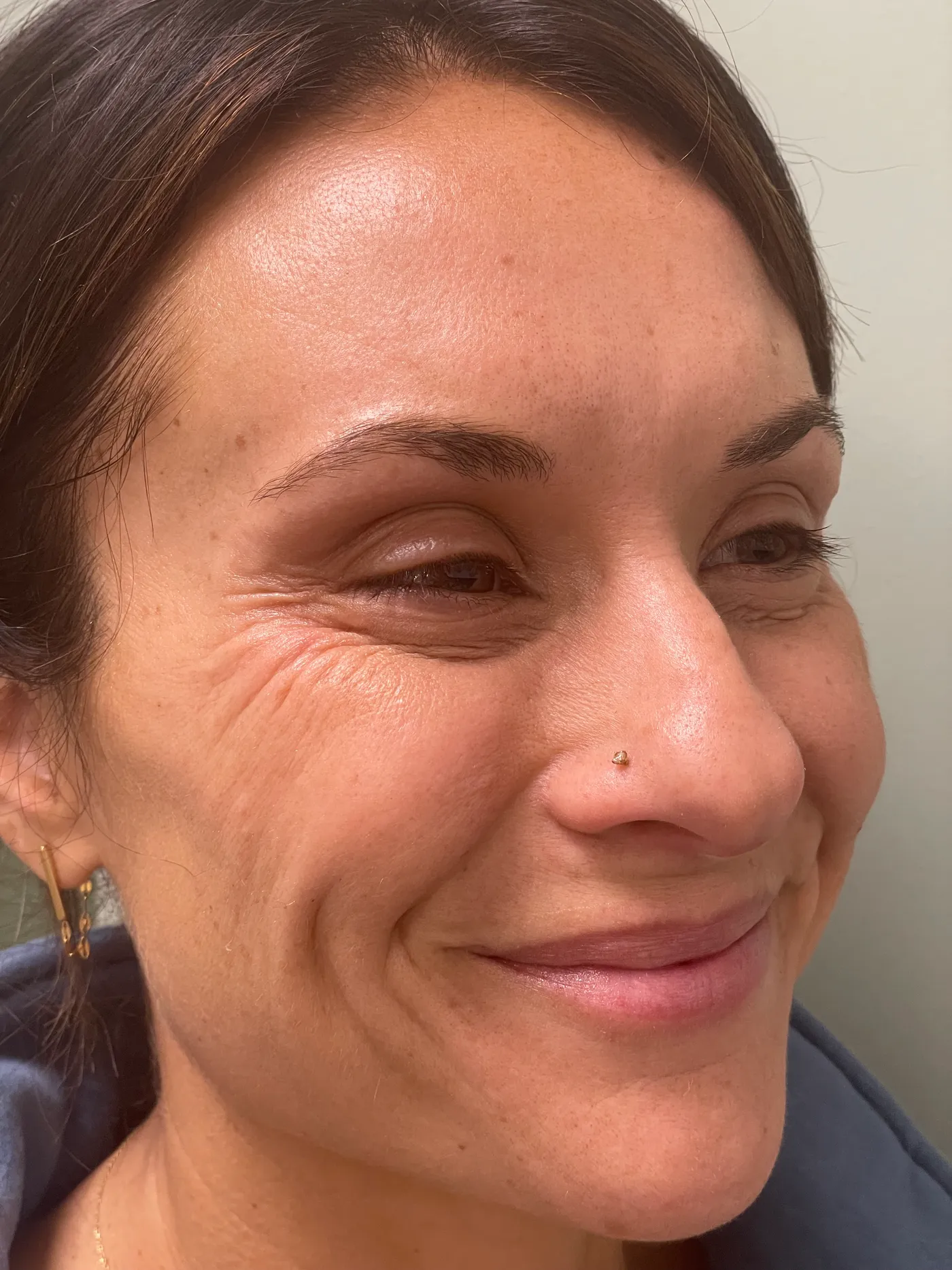 Patient before dermal filler treatment