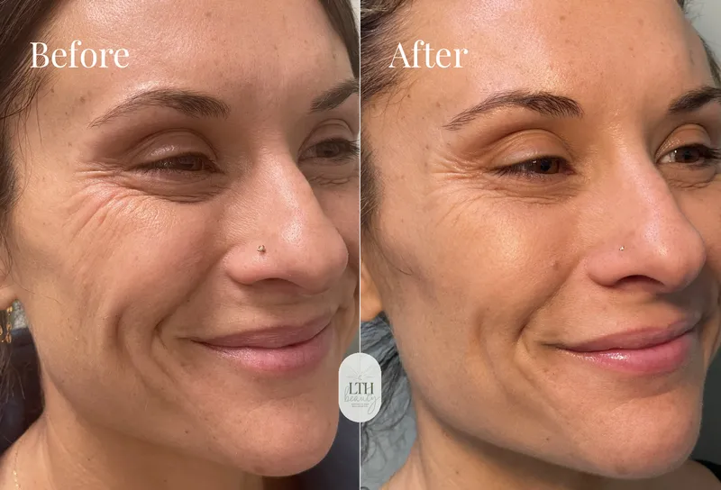 Before and after — full-face dermal filler