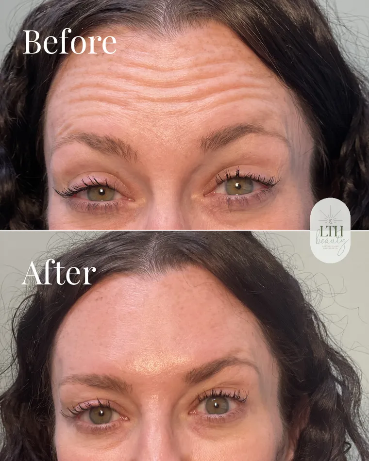 Before and after — neurotoxin treatment for forehead lines (return visit, upper-face view)