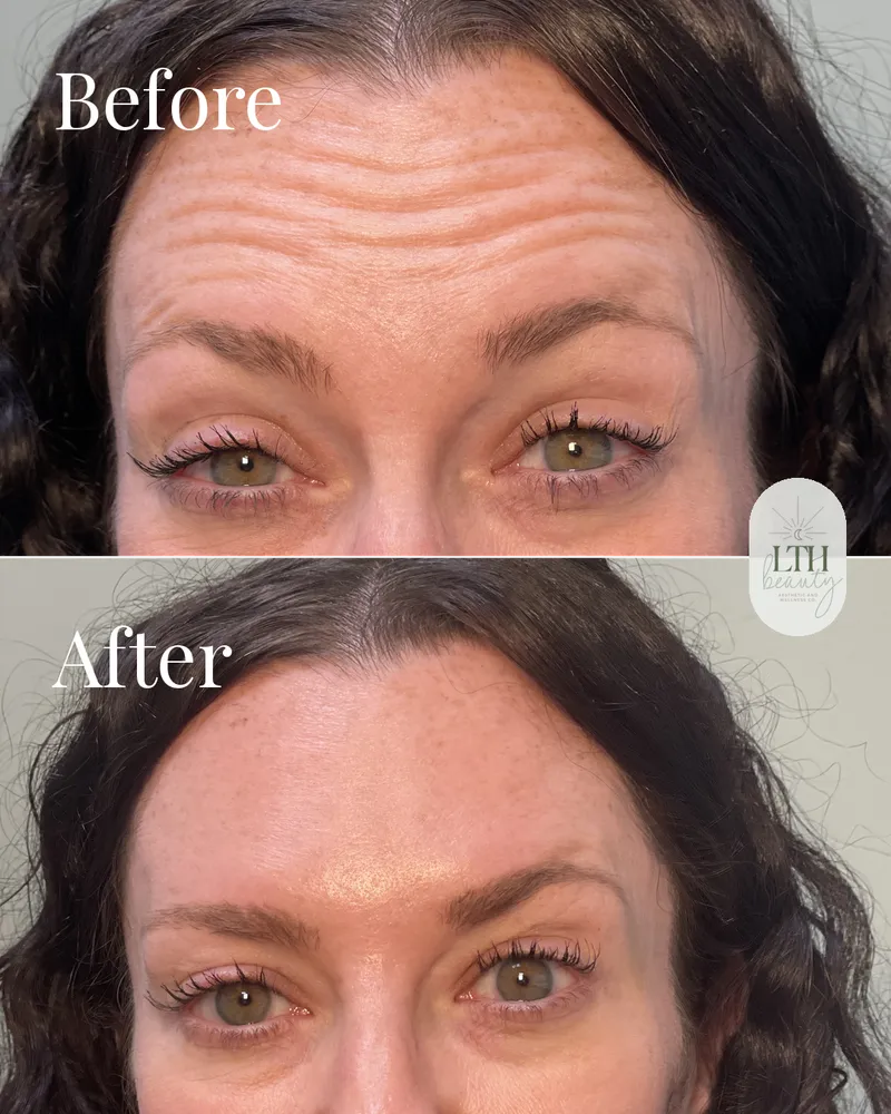 Before and after — neurotoxin treatment for forehead lines (return visit, upper-face view)
