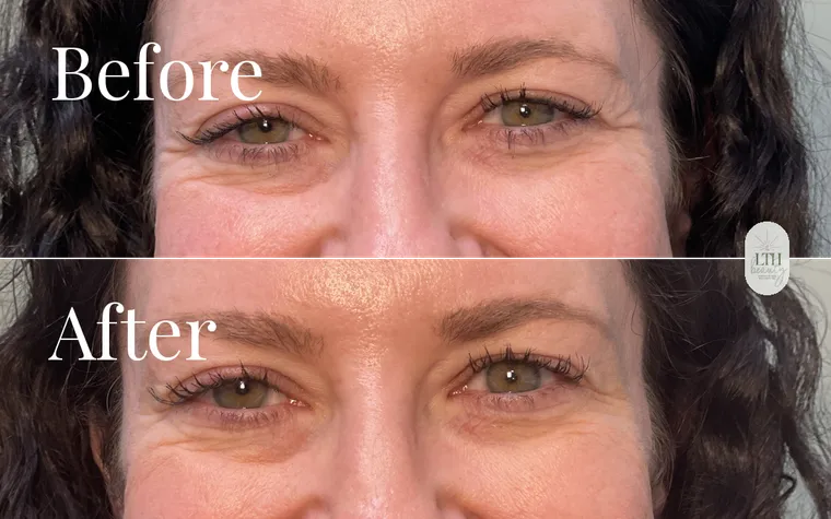 Before and after — neurotoxin treatment for crow's feet