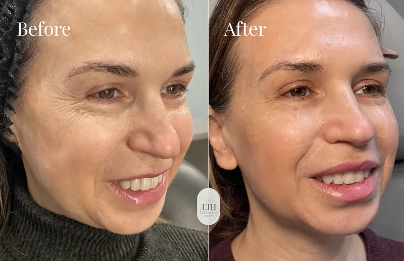 Before and after — Sculptra collagen stimulator (full-face view)