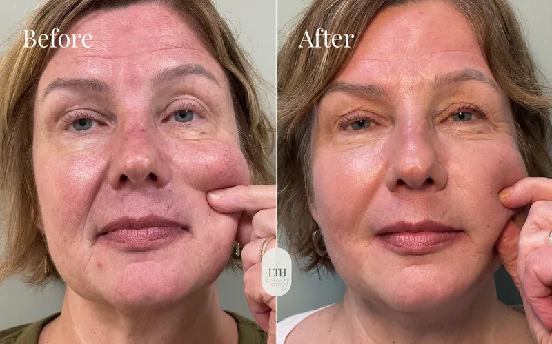 Before and after — Sculptra collagen stimulator (follow-up session, full-face view)