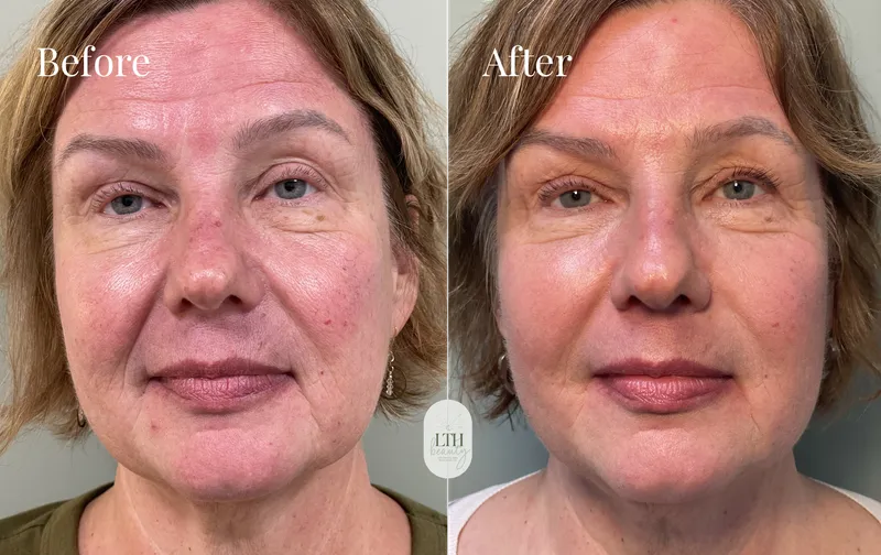 Before and after — Sculptra collagen stimulator (full-face view)