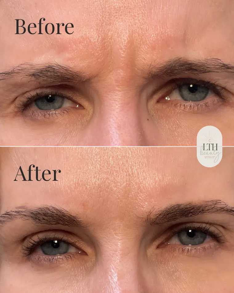 Before and after — neurotoxin treatment for frown lines, the 11s