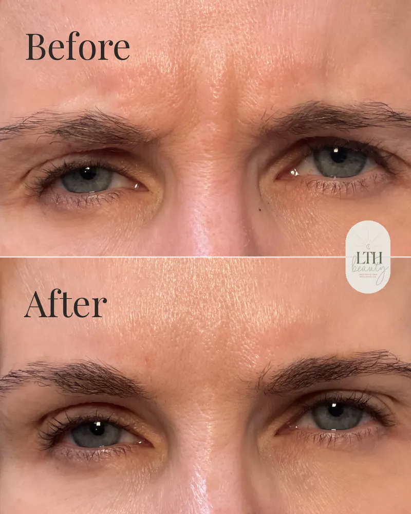 Before and after — neurotoxin treatment for frown lines, the 11s