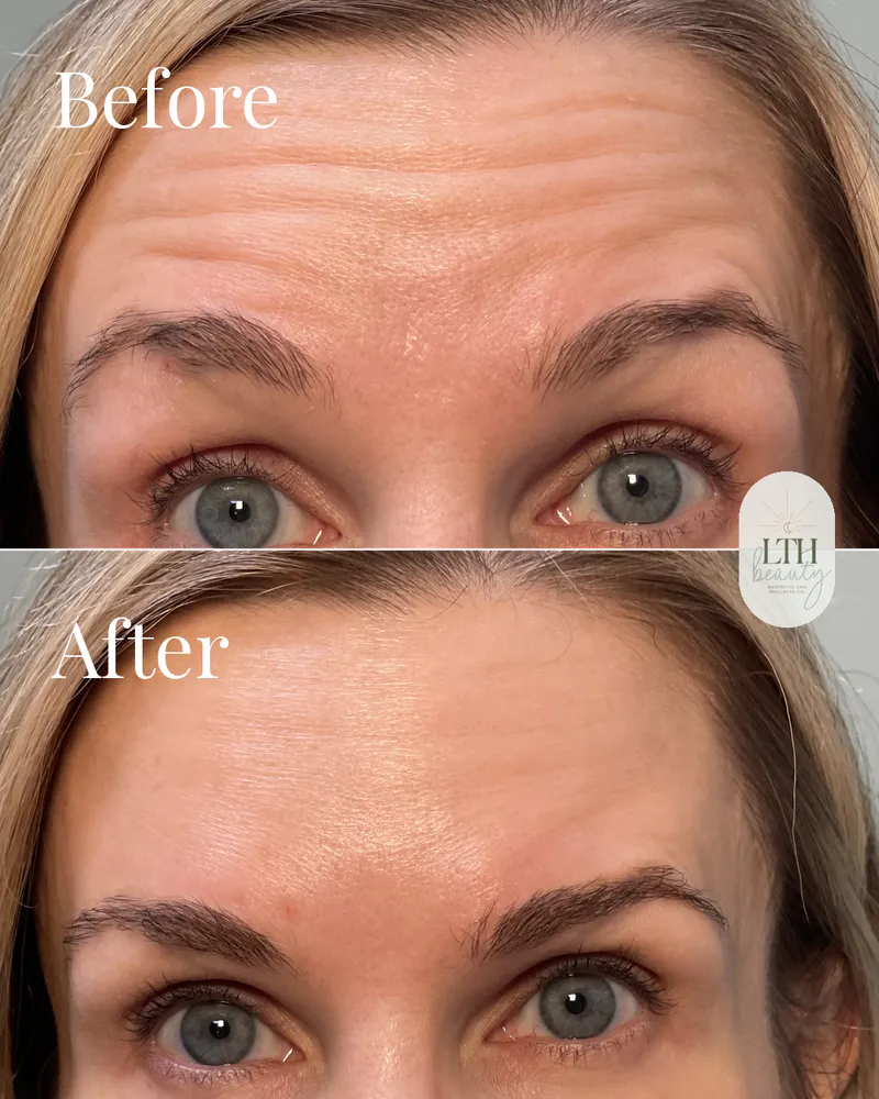 Before and after — neurotoxin treatment for forehead lines (return visit)