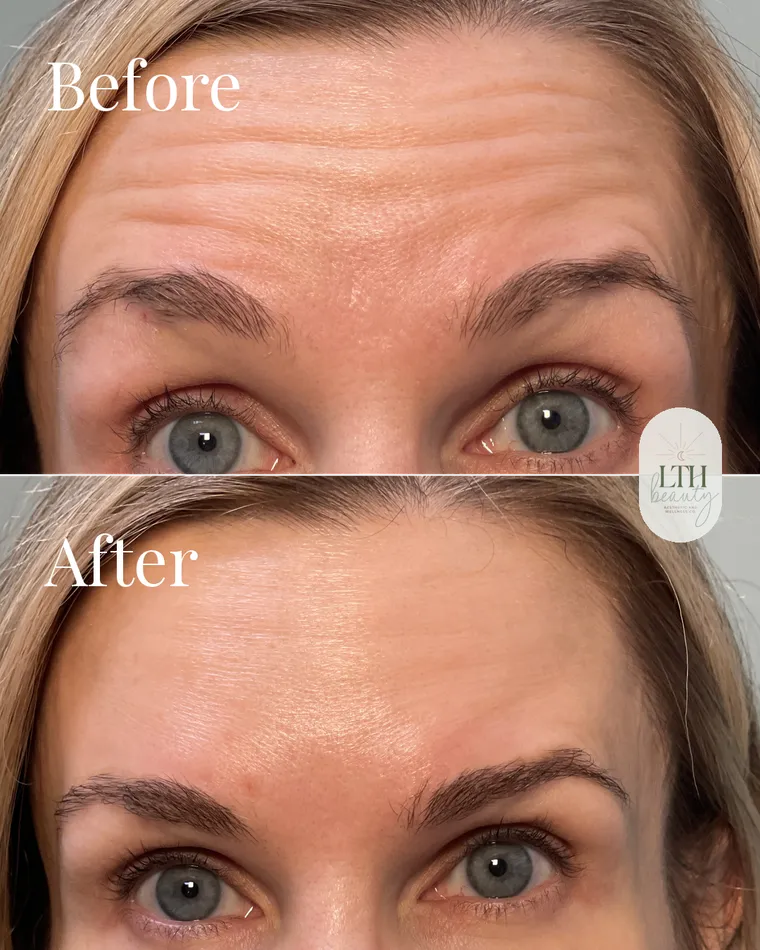 Before and after — neurotoxin treatment for forehead lines (return visit)