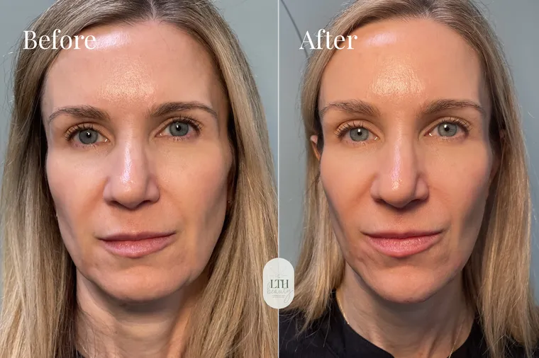 Before and after — chin and jawline filler (full-face view)