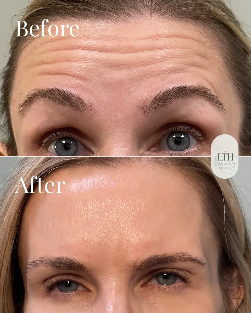 Before and after — neurotoxin treatment for forehead lines