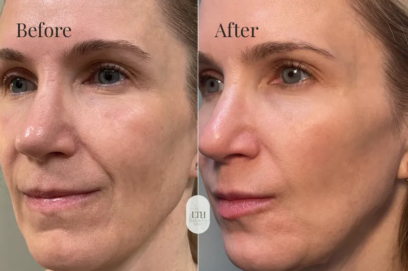 Before and after — dermal filler (full-face view)