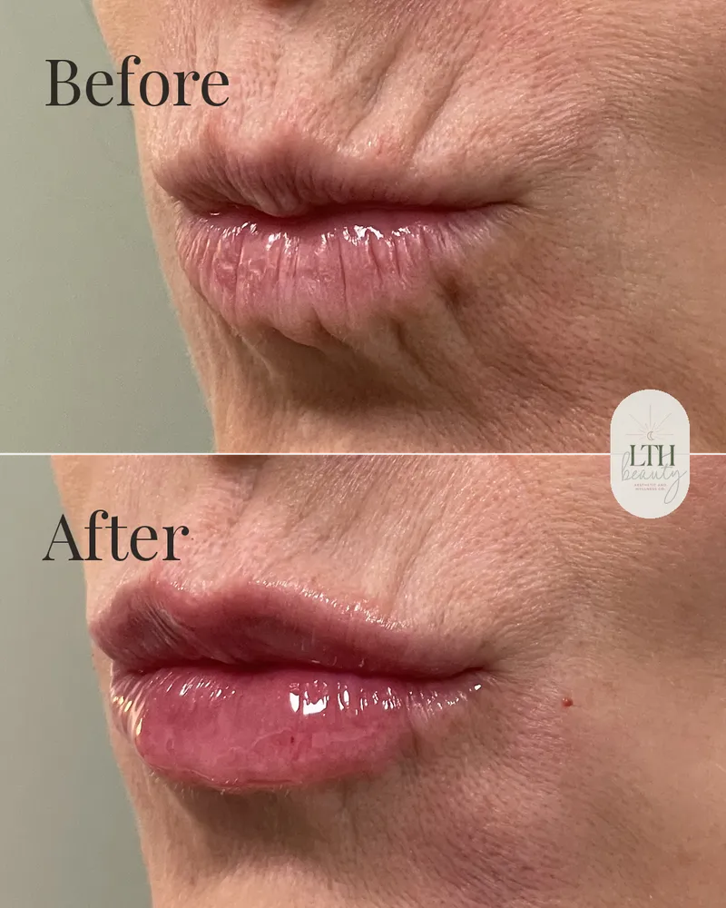 Before and after — lip filler (lip close-up)