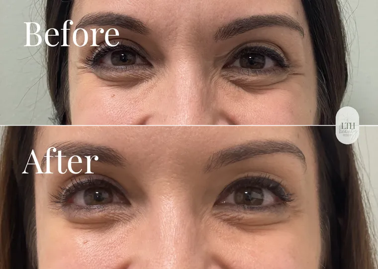 Before and after — neurotoxin treatment for crow's feet