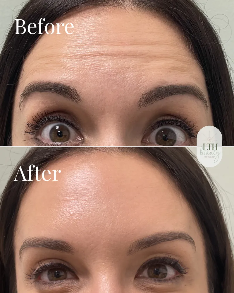 Before and after — neurotoxin treatment to the frontalis for forehead lines