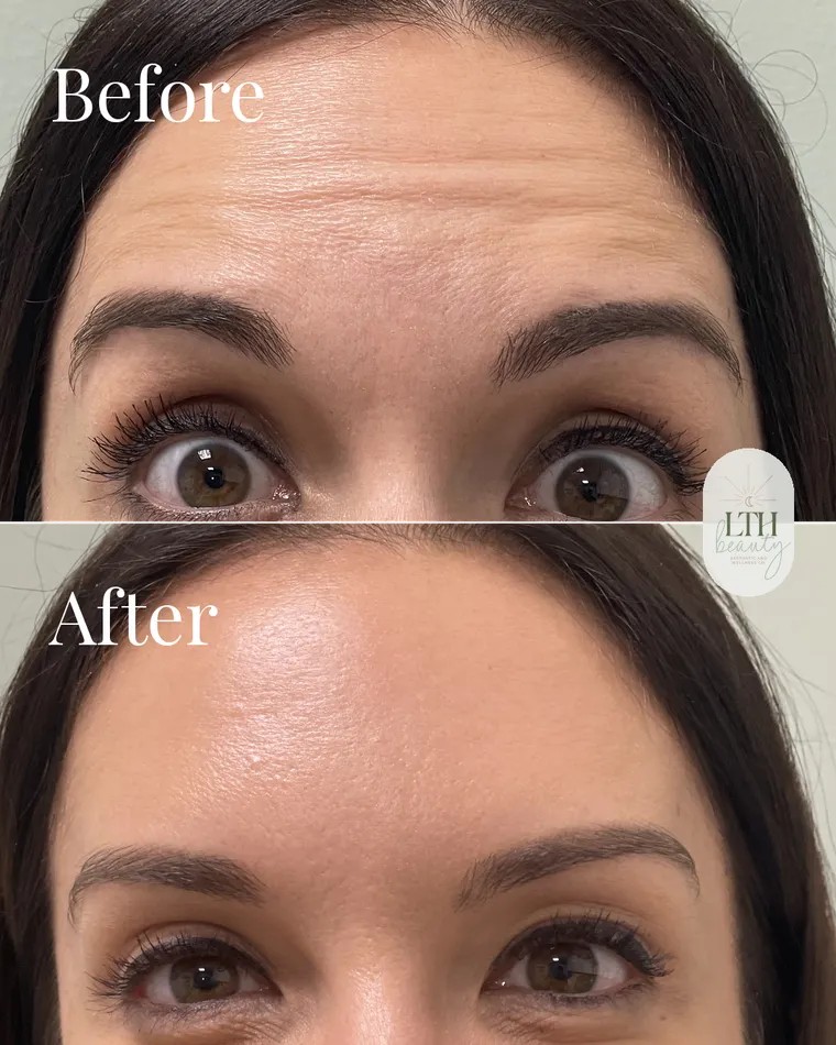 Before and after — neurotoxin treatment to the frontalis for forehead lines