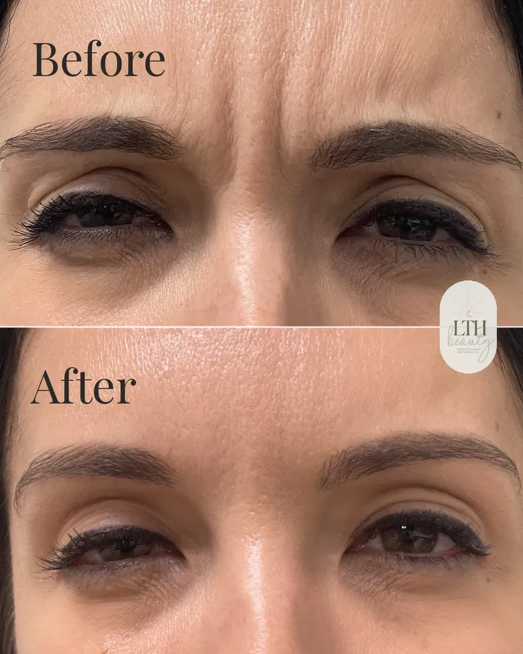 Before and after — neurotoxin treatment to the glabellar muscles for frown lines