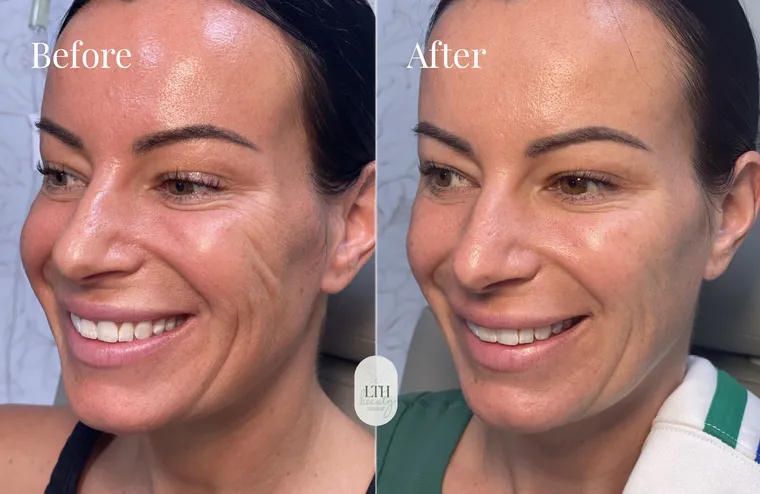 Before and after — dermal filler, full face (three-quarter view)