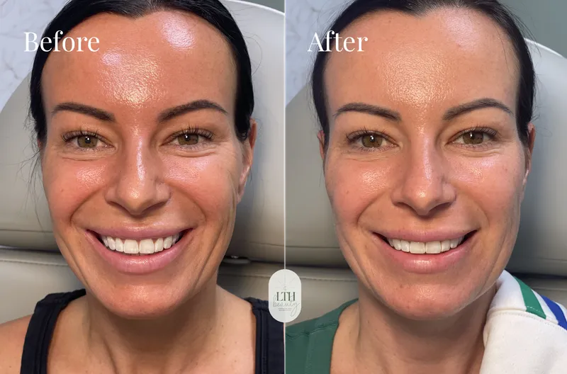 Before and after — dermal filler, full face (straight-on view)