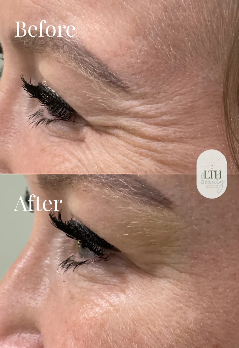 Before and after — neurotoxin treatment for crow's feet, left side