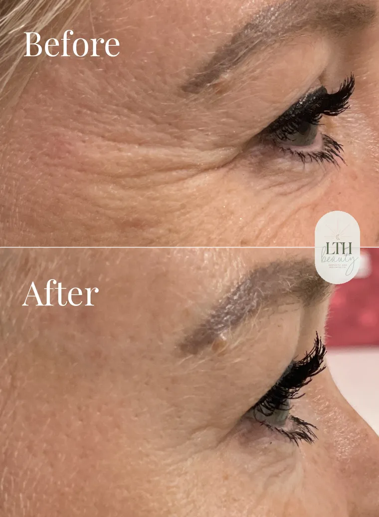 Before and after — neurotoxin treatment for crow's feet, right side