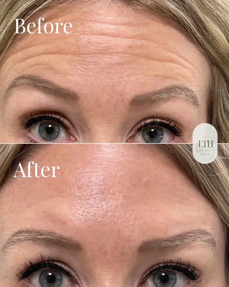 Before and after — neurotoxin treatment for forehead lines