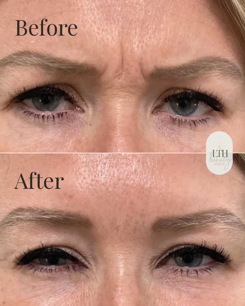 Before and after — neurotoxin treatment for frown lines, the 11s