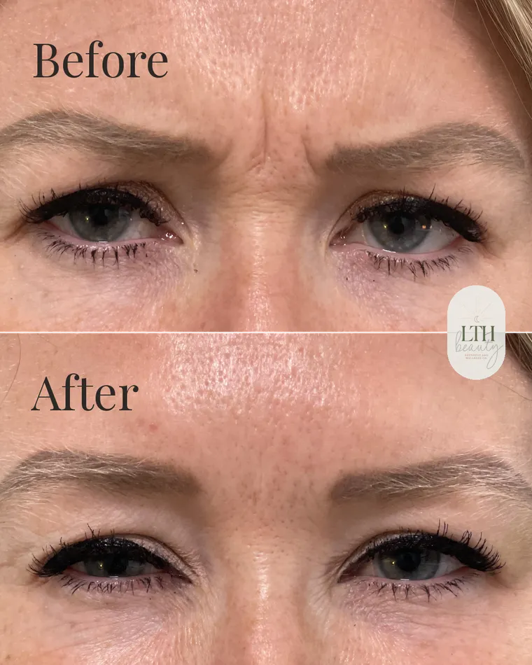Before and after — neurotoxin treatment for frown lines, the 11s