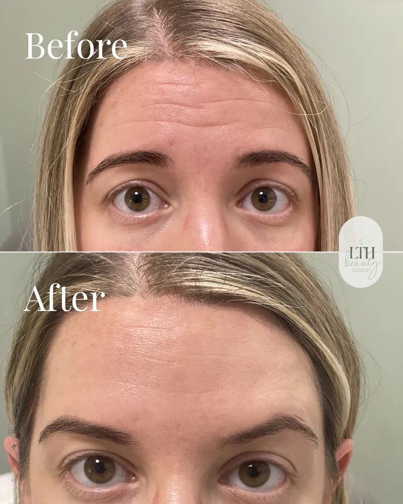 Before and after — neurotoxin treatment to the frontalis for forehead lines (upper-face view)