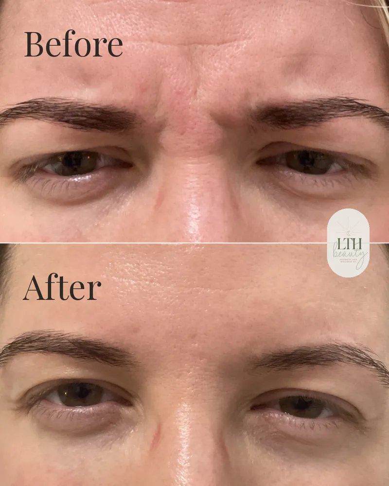 Before and after — neurotoxin treatment to the glabellar muscles for frown lines