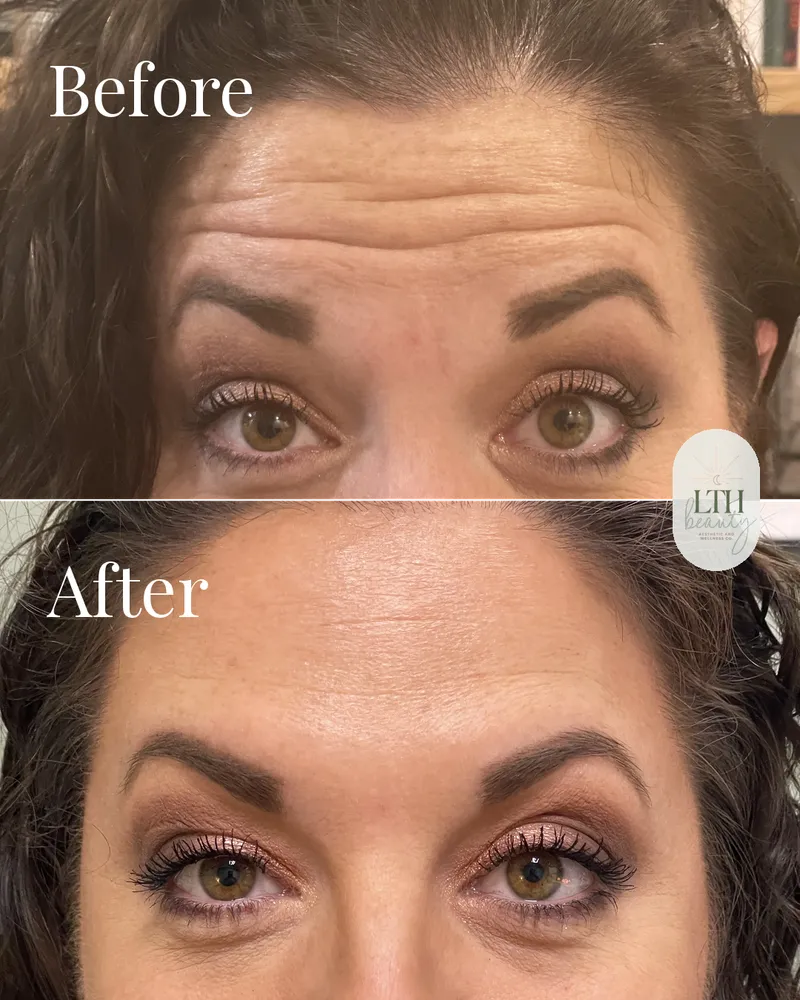 Before and after — neurotoxin treatment to the frontalis for forehead lines (upper-face view)