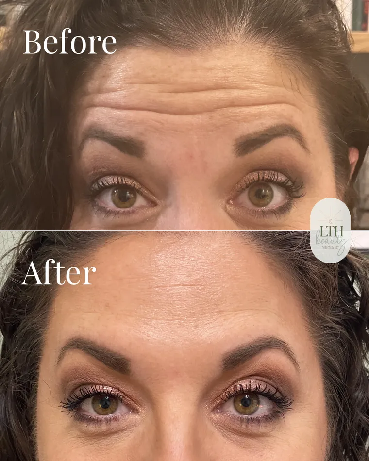 Before and after — neurotoxin treatment to the frontalis for forehead lines (upper-face view)