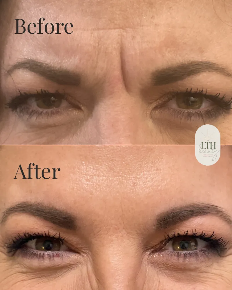 Before and after — neurotoxin treatment to the glabellar muscles for frown lines