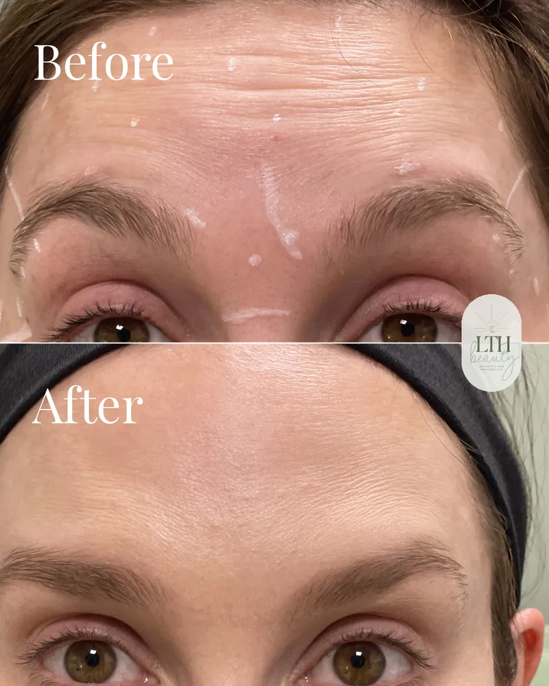Before and after — neurotoxin treatment for forehead lines