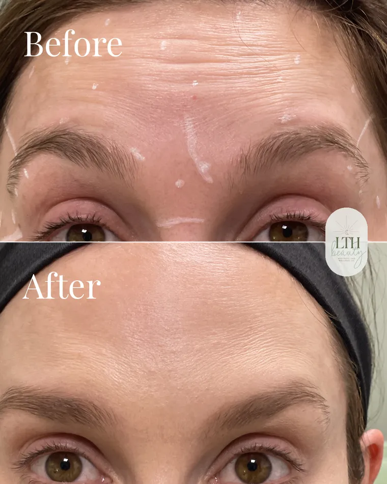 Before and after — neurotoxin treatment for forehead lines