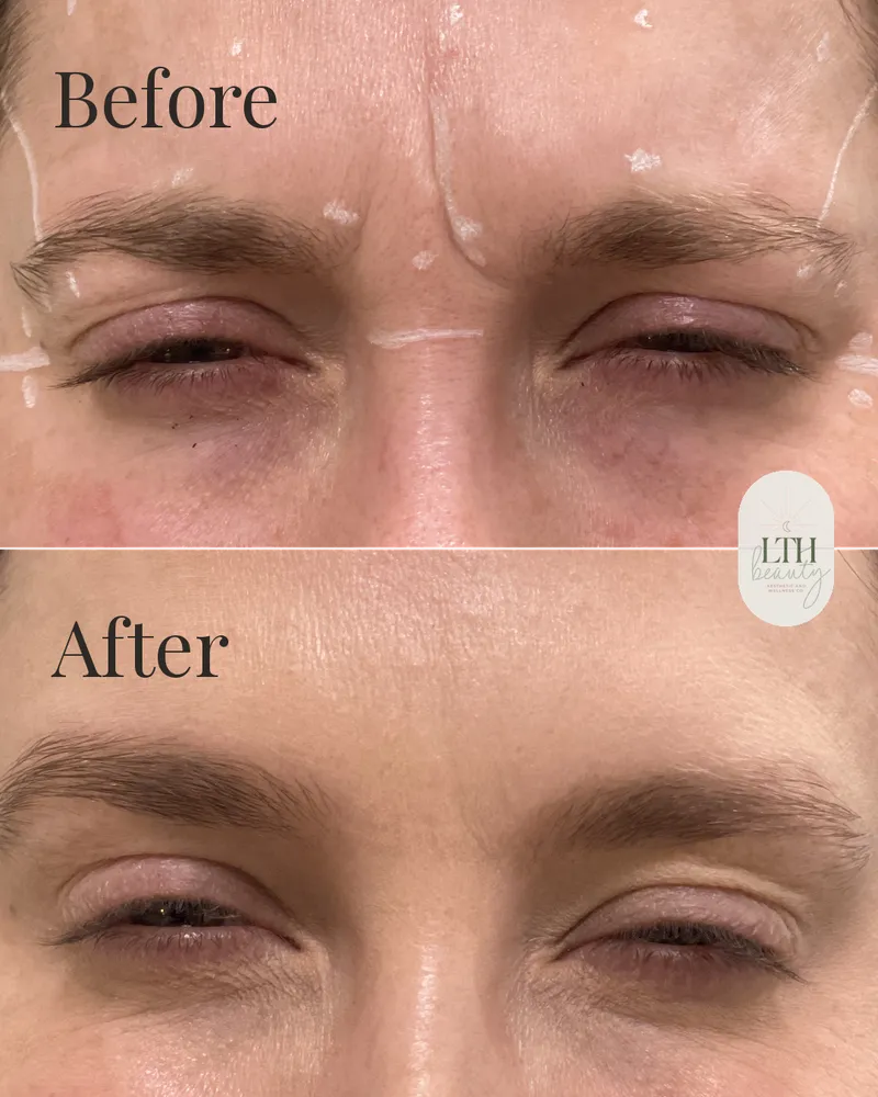 Before and after — neurotoxin treatment to the glabellar muscles for frown lines