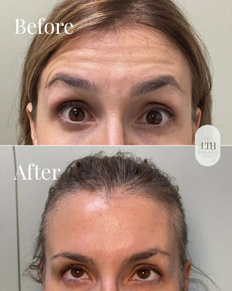 Before and after — neurotoxin treatment for forehead lines (upper-face view)